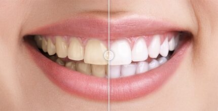 Plugin WordPress de Comparação de Imagens Antes e Depois